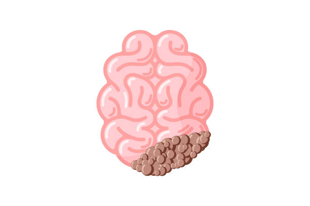 istock Human brain with cancer tumor. Sick suffering damage central nervous system organ. Vector illustration 1187625795