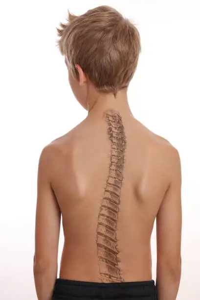 Photo of Scoliosis Spine Curve Anatomy, Posture Correction. Chiropractic treatment, Back pain relief.