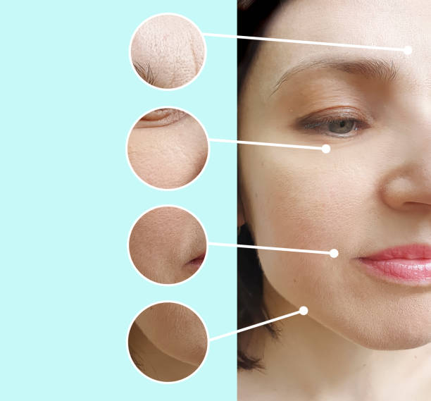 istock woman face wrinkles before and after treatment 1187659879