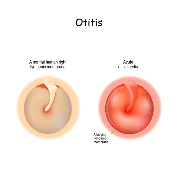 ilustrações de stock, clip art, desenhos animados e ícones de healthy membrane, and bulging tympanic membrane of acute otitis media - eustachian tube