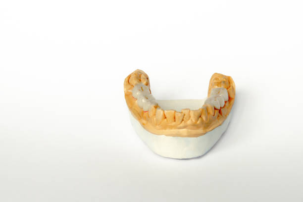 istock false teeth. bridge-ceramic-metal prostheses. Ceramic teeth dentures on the plaster model of the lower jaw 1187895910