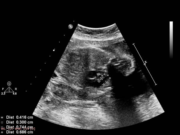 istock Ultrasound screen with fetal echocardiography. 1187957536