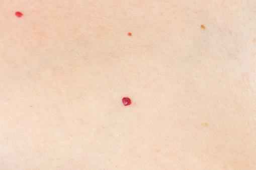 angioma. red mole on the skin. bursting vessel capillary. many angiomas in a small area of ​​the body. close-up.