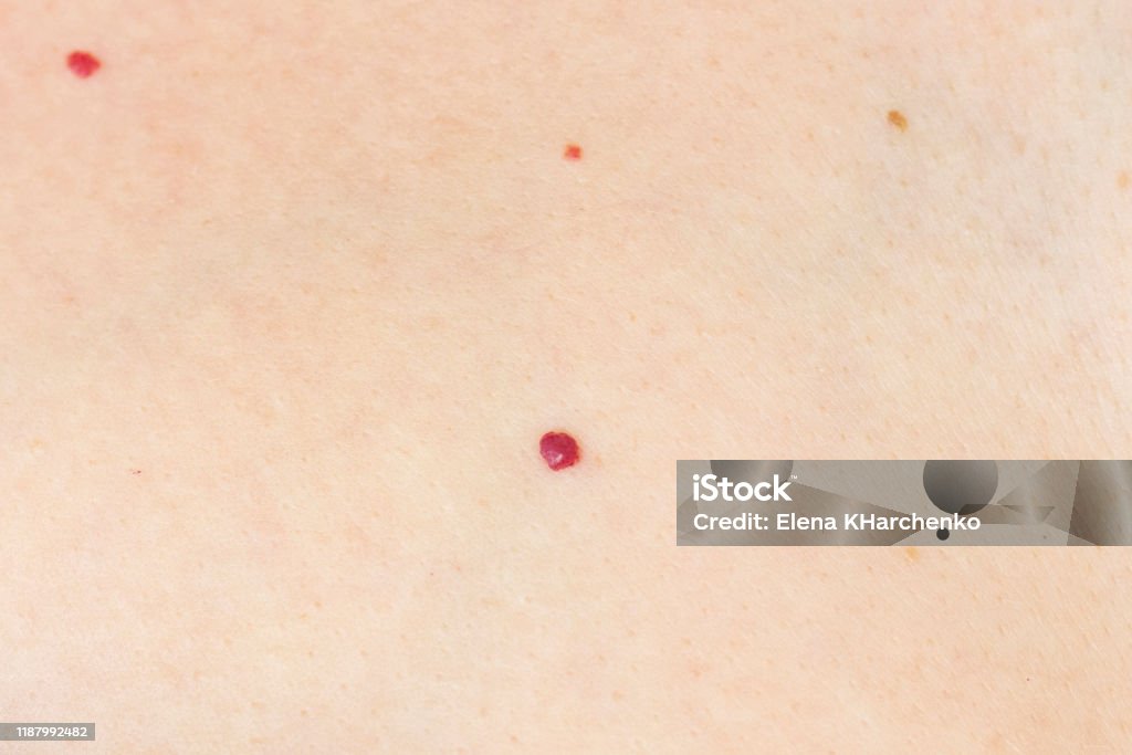 Angioma Red Mole On The Skin Bursting Vessel Capillary Many Angiomas In