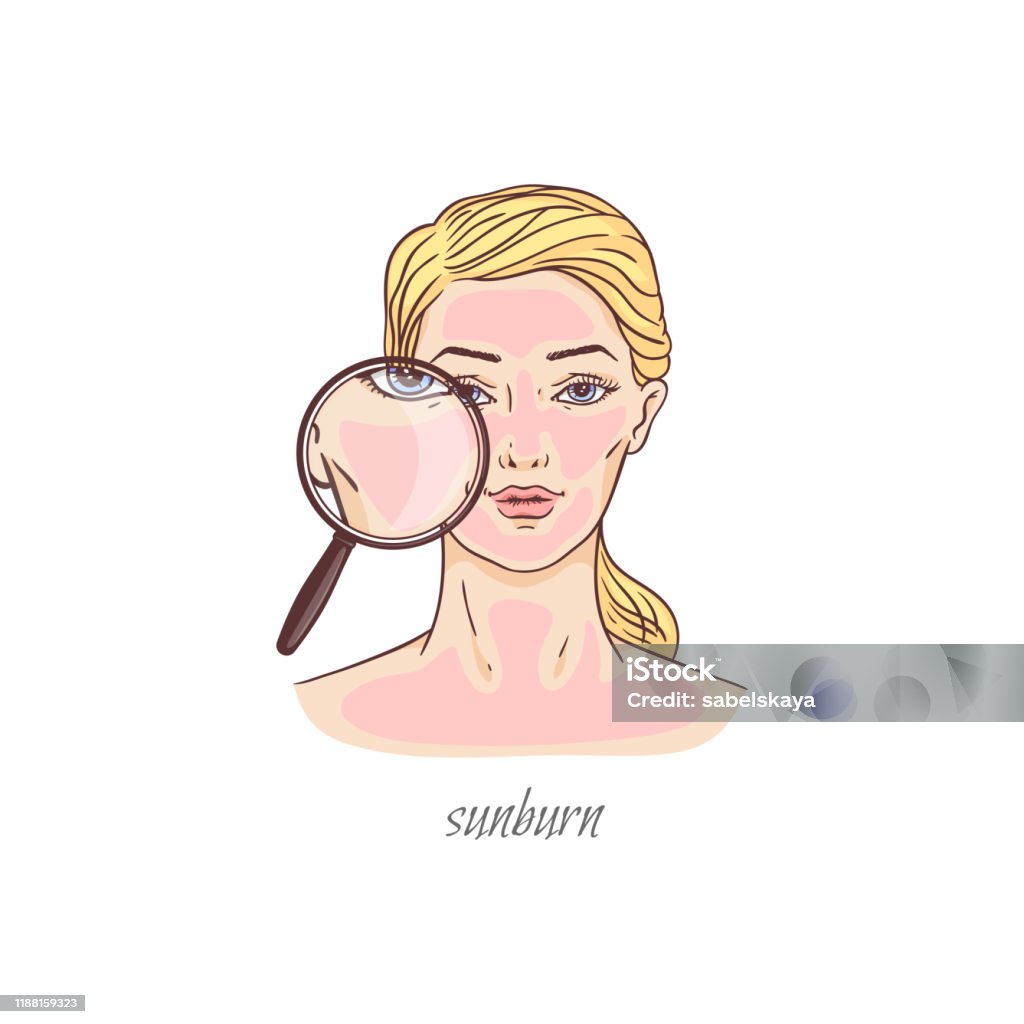 Ilustración de Mujer De Dibujos Animados Con Quemaduras Solares Graves Piel Roja Rosa De La Cara y más Vectores Libres de Derechos de Mejillas enrojecidas - iStock Ilustración de Mujer De Dibujos Animados Con Quemaduras Solares Graves Piel Roja Rosa De La Cara y más Vectores Libres de Derechos de Mejillas enrojecidas - iStock