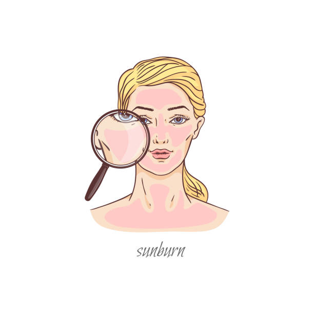 Cartoon woman with severe sunburn - red pink face skin Cartoon woman with severe sunburn - red pink face skin shown on magnifying looking glass. Summer holiday skincare problem - isolated flat vector illustration. rosy cheeks stock illustrations