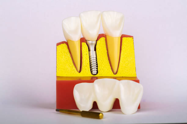 istock Dental Implant Model. Modern stomatology concept. Selective focus. Space for text. 1188213067