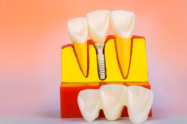 istock Dental Implant Model. Modern stomatology concept. Selective focus. Space for text. 1188214697