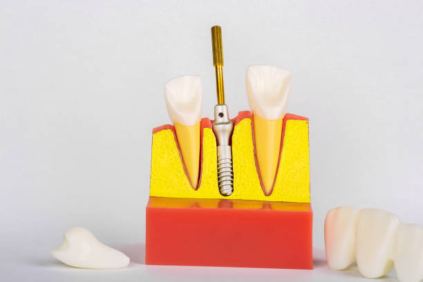 istock Dental Implant Model. Modern stomatology concept. Selective focus. Space for text. 1188214733