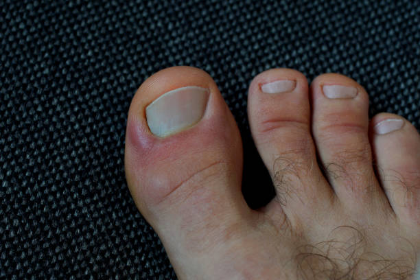 close up of a red, inflamed, painful toe inflamed nail bed (paronychia / panaritum) due to a micotrauma or an ingrown nail; Sony DSLR, Tamron 90mm bed of nails stock pictures, royalty-free photos & images