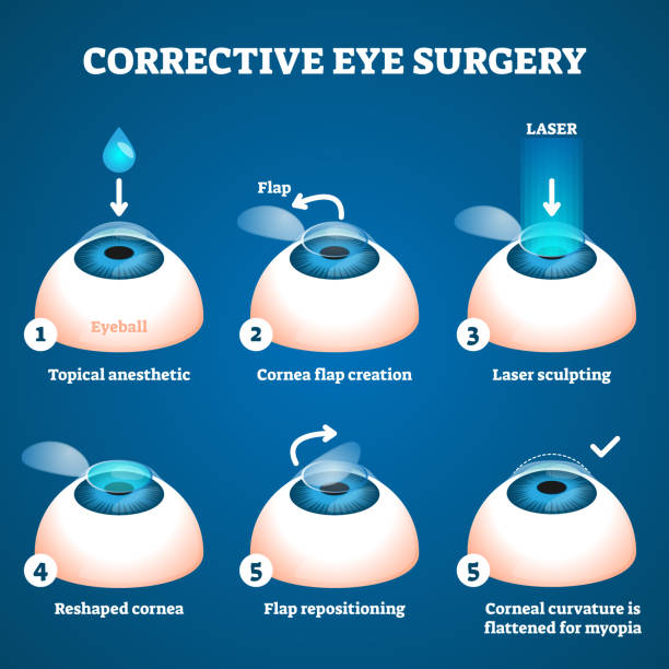 ilustrações, clipart, desenhos animados e ícones de ilustração corretiva do vetor da cirurgia de olho. esquema de educação de processo a laser. - cornea