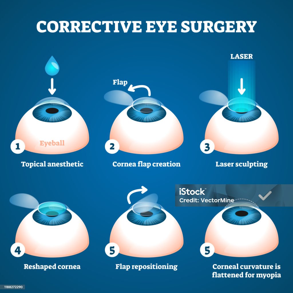 Corrective eye surgery vector illustration. Laser process education scheme. Corrective eye surgery vector illustration. Laser process education scheme. Sight improvement with LASIK technology. Procedure process stages visualization with cornea flap creating and sculpting. Eye Surgery stock vector