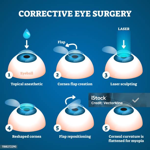 Corrective Eye Surgery Vector Illustration Laser Process Education Scheme Stock Illustration - Download Image Now