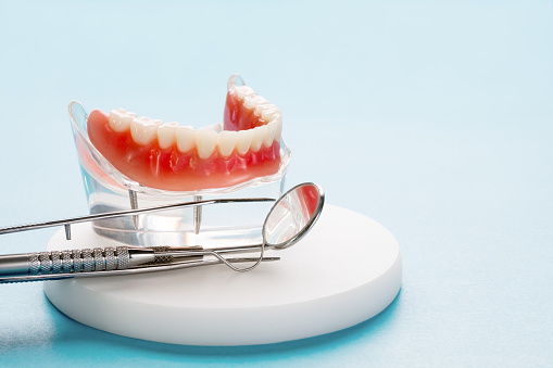 Modelo de dientes que muestra un modelo de puente de corona de implante. photo