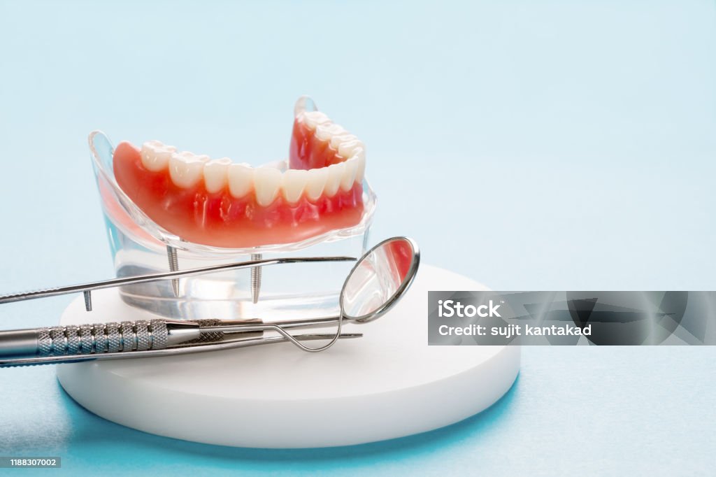 Teeth model showing an implant crown bridge model. Teeth model showing an implant crown bridge model/ dental demonstration teeth study teach model. Dentures Stock Photo