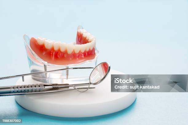 Teeth Model Showing An Implant Crown Bridge Model Stock Photo - Download Image Now - Dentures, Dental Health, Teeth
