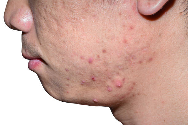 アジアの男性の顔にクローズアップにきびと傷跡 - dry skin close up horizontal macro ストックフォトと画像
