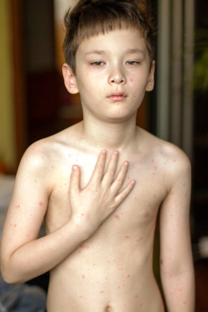 istock Poor boy with chickenpox. Sad little boy itching the body. Chickenpox rash 1188388593