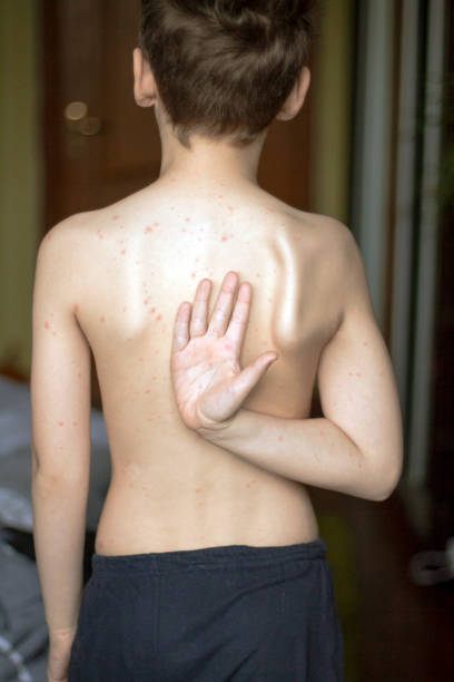 istock Poor boy with chickenpox. Sad little boy itching the body. Chickenpox rash 1188388667