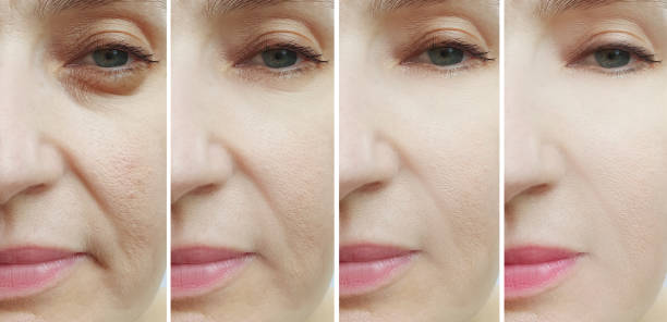 istock woman face wrinkles before and after treatment collage 1188454329