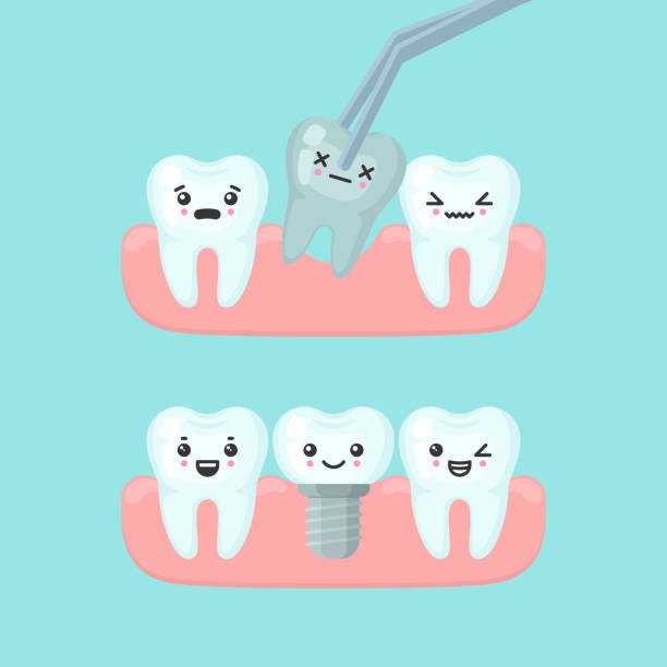 Tooth extraction and implantation stomatology concept, cute colorful teeth implant vector illustration Tooth extraction and implantation stomatology concept. Cute cartoon vector teeth implant isolated illustration cute cartoon dental implants stock illustrations