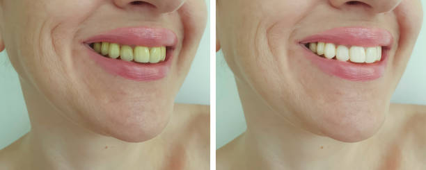 istock woman teeth before and after whitening 1188595077