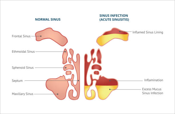 Medical infographic of sinus and human nasal anatomy. Medical infographic of sinus, normal sinus and sinus infection or sinusitis. Isolated vector flat illustration, human nasal anatomy. septum stock illustrations