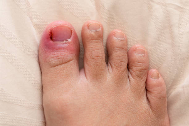 2,537 Infected Toenail Stock Photos, Pictures & Royalty-Free Images - iStock