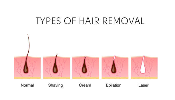 Comparison Of The Popular Methods Of Hair Removal Stock Illustration -  Download Image Now - Hair Removal, Laser, Variation - iStock