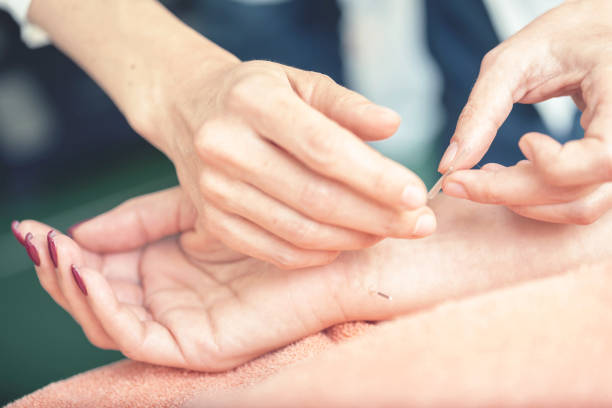 Woman on acupuncture