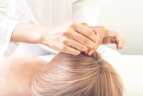 mulher na acupunctura - head massage headache massaging alternative therapy - fotografias e filmes do acervo