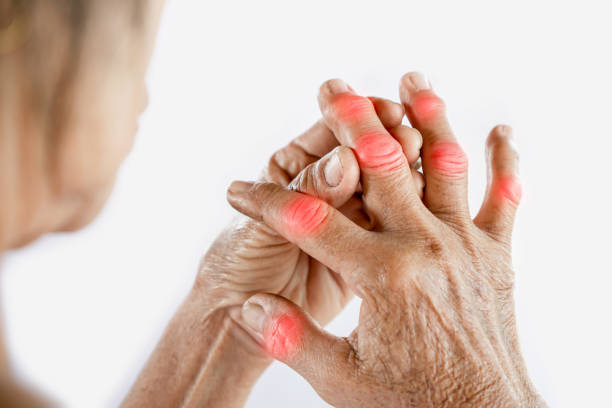 donna asiatica mano che soffre di dolori articolari con gotta al dito - artrite foto e immagini stock