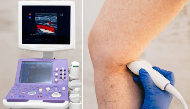 bijgesneden echografie onderzoek aders op het been, veneuze trombose, spataderen - woman legs veins stockfoto's en -beelden