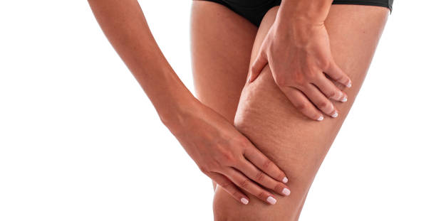 istock Cellulite on female legs. 1188915314