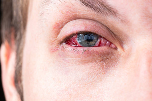 istock postoperative heavy inflamed eye closeup shot with selective focus 1188960427