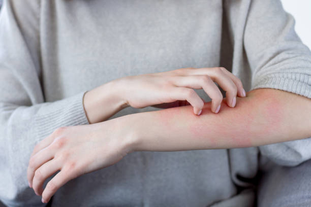 mujer enferma con alergia. concepto de atención médica - itchy skin fotografías e imágenes de stock