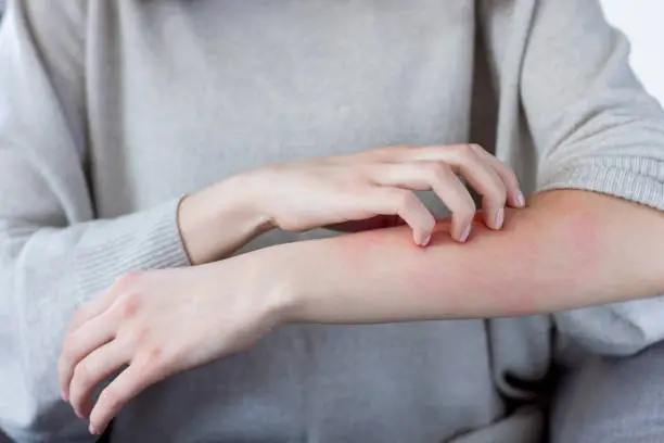 Closeup girl is scratching her hand with nails. Reddened, inflamed body parts causes discomfort and itching. Young woman is suffering from bouts of allergies. Dermatological skin diseases concept.