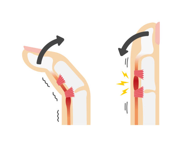 ilustraciones, imágenes clip art, dibujos animados e iconos de stock de desencadenar la ilustración de las causas y síntomas del dedo / sin texto - tendon sheaths and carpal bones