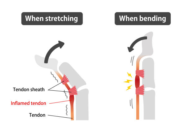 ilustraciones, imágenes clip art, dibujos animados e iconos de stock de desencadenar las causas del dedo y los síntomas de la ilustración / inglés - tendon sheaths and carpal bones