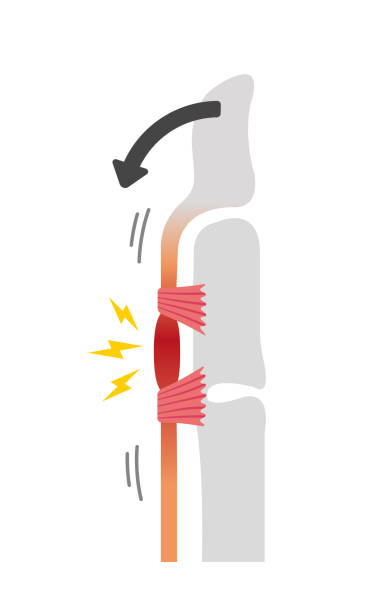 триггер палец причины и симптомы иллюстрации / при изгибе - tendon sheaths and carpal bones stock illustrations