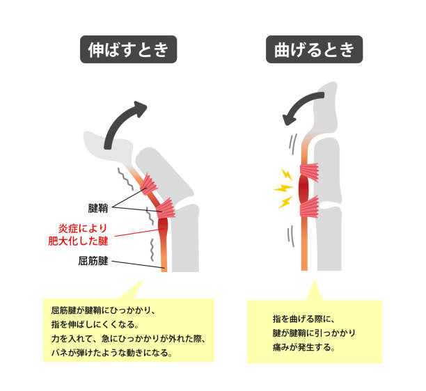 триггер палец причины и симптомы иллюстрации / японский (с текстами объяснений) - tendon sheaths and carpal bones stock illustrations