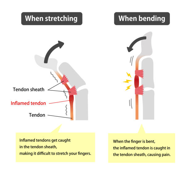 ilustraciones, imágenes clip art, dibujos animados e iconos de stock de desencadenar la ilustración de causas y síntomas del dedo / inglés (con textos explicativos) - tendon sheaths and carpal bones