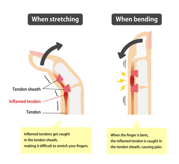 ilustraciones, imágenes clip art, dibujos animados e iconos de stock de desencadenar la ilustración de causas y síntomas del dedo / inglés (con textos explicativos) - tendon sheaths and carpal bones