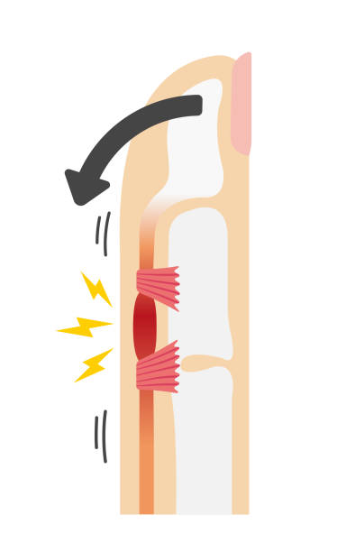 ilustraciones, imágenes clip art, dibujos animados e iconos de stock de desencadenar la ilustración de las causas y síntomas del dedo / al doblar - tendon sheaths and carpal bones