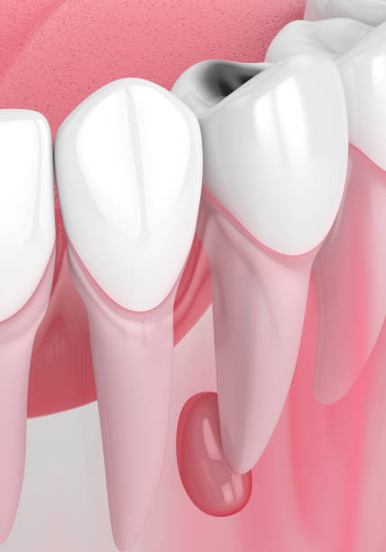 istock 3d render of jaw with tooth cavity and cyst 1189299394