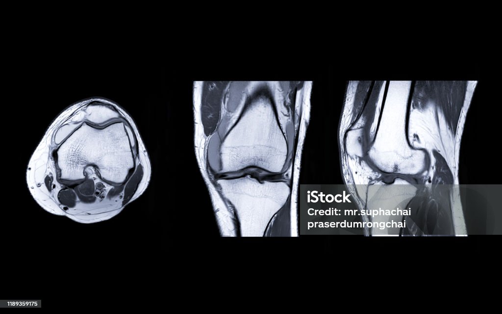 MRI Knee joint  3view MRI Knee joint or Magnetic resonance imaging  compare axial,  coronal and sagittal view for detect tear or sprain of the anterior cruciate  ligament (ACL). MRI Scanner Stock Photo