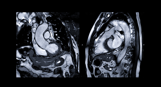 La RMN cardíaca o la RESONANCIA magnética cardíaca (imágenes por resonancia magnética) del corazón comparan RVOT y LVOT para el diagnóstico de enfermedades cardíacas. photo