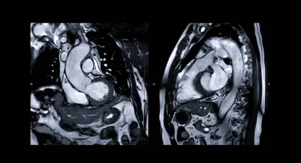 Photo of MRI heart or Cardiac MRI ( magnetic resonance imaging ) of heart compare RVOT and LVOT for diagnosis heart disease.