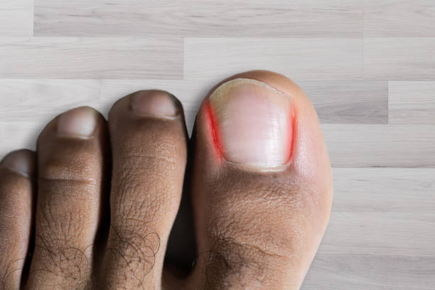 istock An Elevated View Of Sore Toe Nail On Floor 1189507342