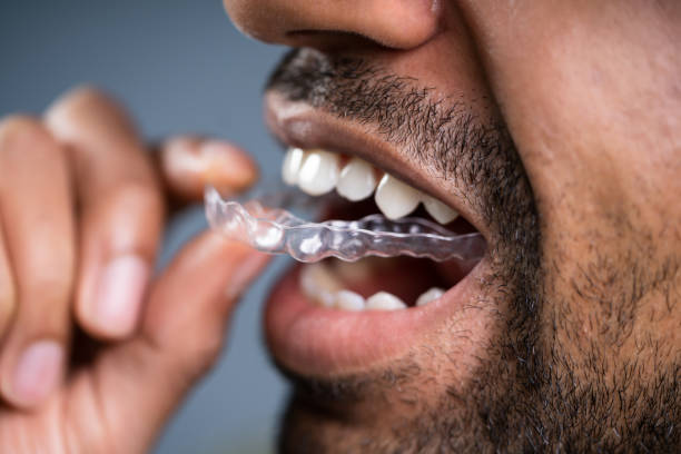 Man Putting Transparent Aligner In Teeth Close-up Of A Man's Hand Putting Transparent Aligner In Teeth dental aligner photos stock pictures, royalty-free photos & images